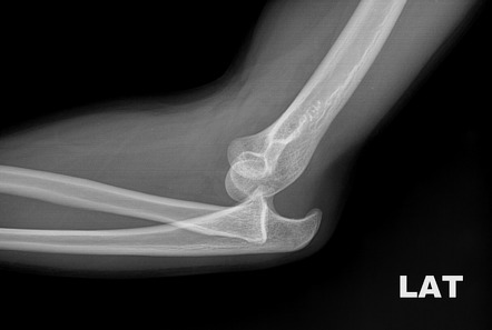 elbow dislocation classification