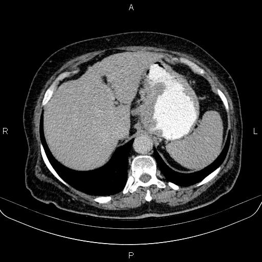 Gastric adenocarcinoma | Image | Radiopaedia.org