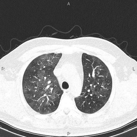 Pulmonary alveolar proteinosis | Radiology Reference Article ...