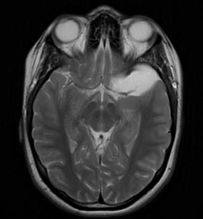 Arachnoid cyst - middle cranial fossa | Image | Radiopaedia.org