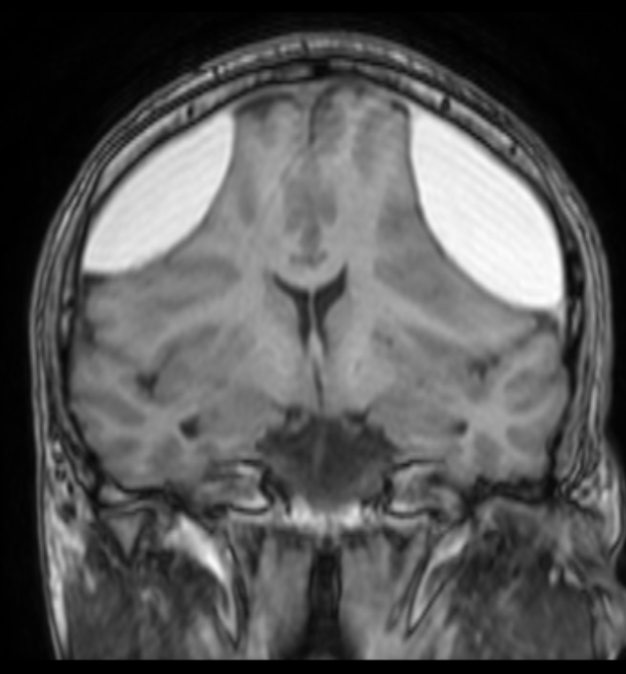 Bilateral subacute subdural hematoma | Image | Radiopaedia.org