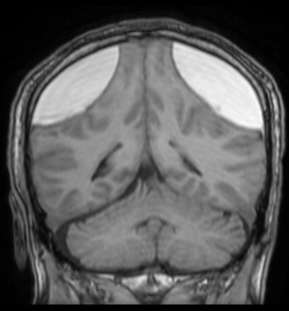 Bilateral subacute subdural hematoma | Radiology Case | Radiopaedia.org