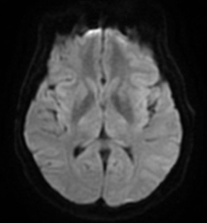 Bilateral Subacute Subdural Hematoma Image