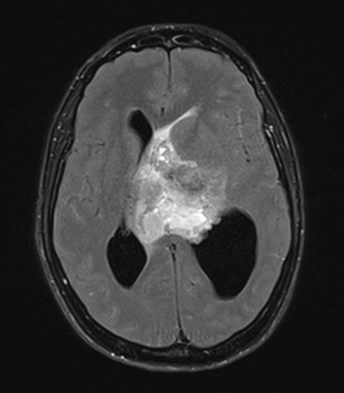 Central neurocytoma | Image | Radiopaedia.org