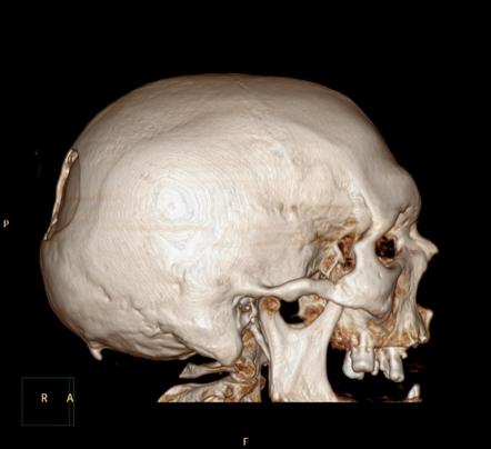 Depressed skull fracture | Image | Radiopaedia.org