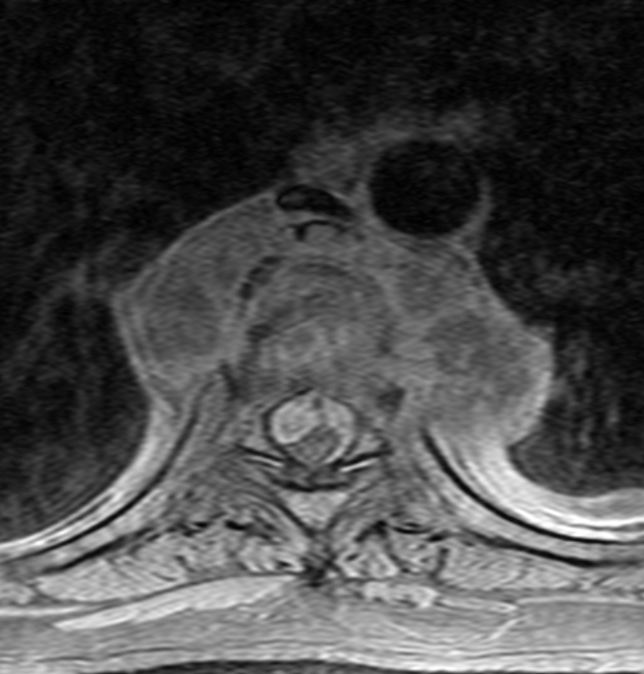 Tuberculous Spondylodiscitis - Dorsal | Image | Radiopaedia.org