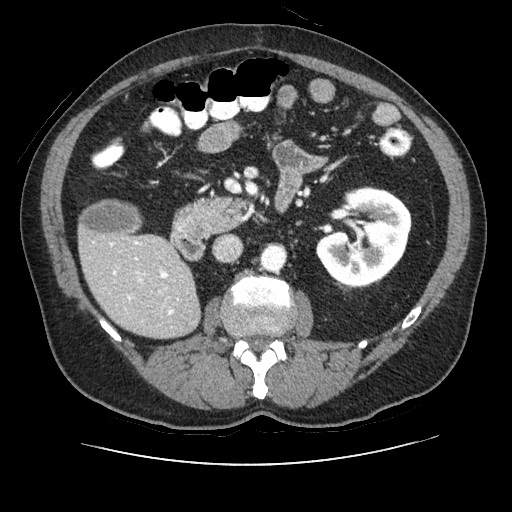 Ectopic right pelvic kidney | Image | Radiopaedia.org