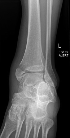 Medial malleolar and lateral talar dome fractures | Image | Radiopaedia.org