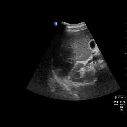 Hepatic abscess | Radiology Reference Article | Radiopaedia.org