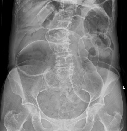 Pneumoperitoneum | Radiology Case | Radiopaedia.org