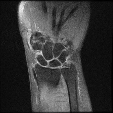 Base of fifth metacarpal fracture (MRI) | Image | Radiopaedia.org