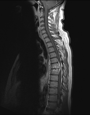 Spinal Epidural Abscess 