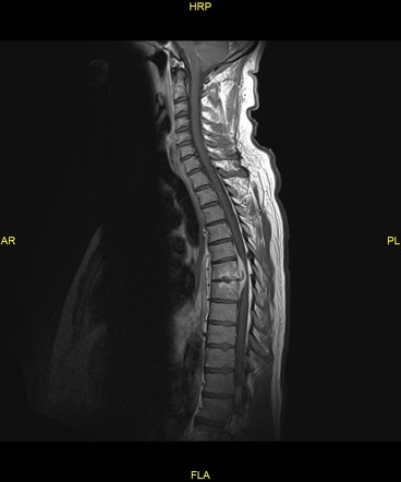 Spinal Epidural Abscess Radiology Reference Article Radiopaedia Org