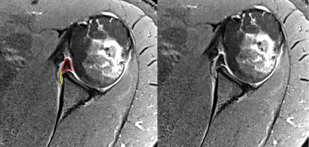 Perthes lesion | Radiology Case | Radiopaedia.org