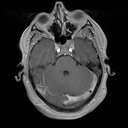 Dural venous sinus thrombosis | Radiology Reference Article ...