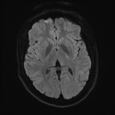 Arachnoid granulation | Image | Radiopaedia.org