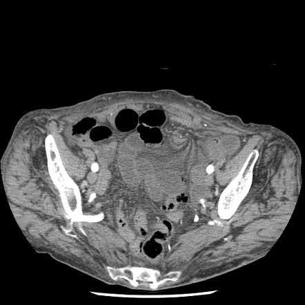 Closed loop small bowel obstruction - adhesions and infarct | Radiology ...