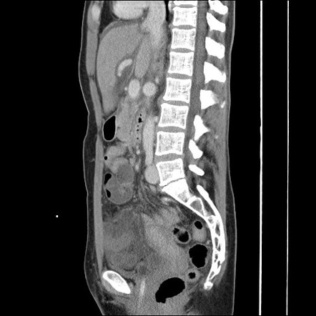 Transomental Internal Hernia Leading To Closed Loop Obstruction 