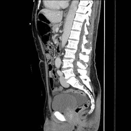 Closed loop small bowel obstruction - omental adhesion causing ...