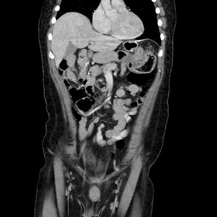 Roux-en-Y gastric bypass internal hernia: right-sided anastomosis ...