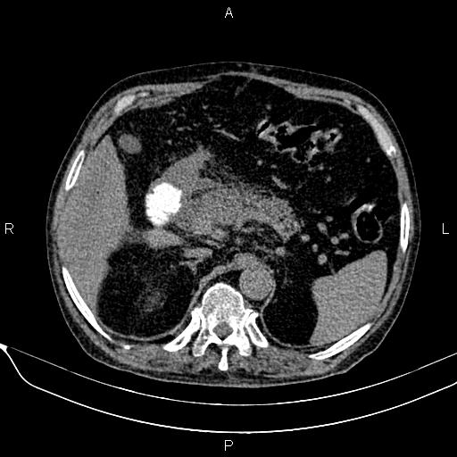 Acute pancreatitis | Image | Radiopaedia.org