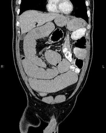 Partial small bowel loops obstruction | Radiology Case | Radiopaedia.org