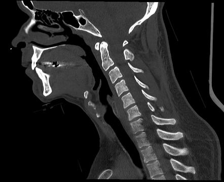 CT cervical spine (protocol) | Radiology Reference Article ...