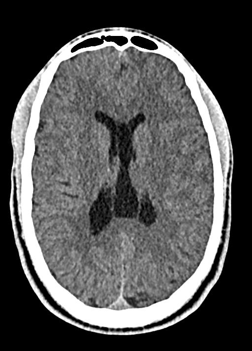 Learning Neuroradiology Case 1404 Cavum Septum