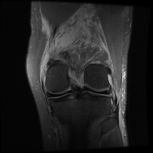 Hyperextension and posteromedial corner injury pattern with Baker cyst ...