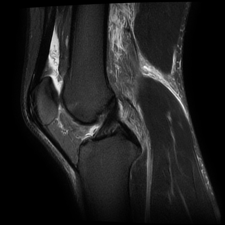 Hyperextension and posteromedial corner injury pattern with Baker cyst ...