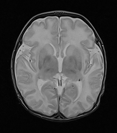 Neonatal hypoxic ischemic encephalopathy | Image | Radiopaedia.org