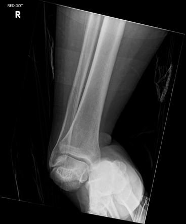 Total talar dislocation | Radiology Reference Article | Radiopaedia.org