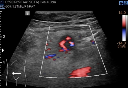 Acute Appendicitis | Radiology Case | Radiopaedia.org