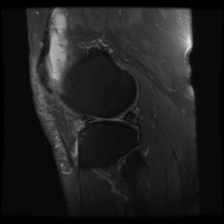 Displaced lateral meniscal flap tear | Radiology Case | Radiopaedia.org