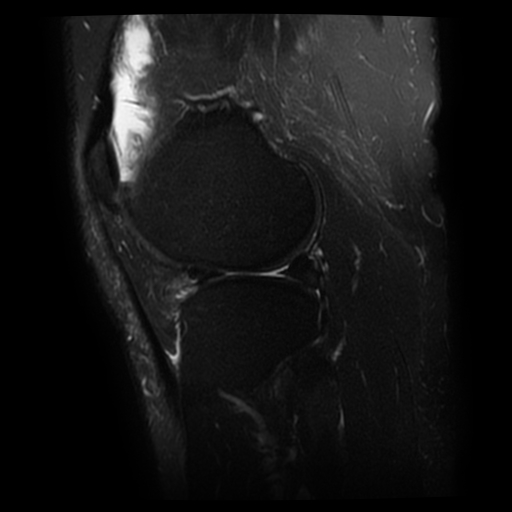 Displaced lateral meniscal flap tear | Image | Radiopaedia.org