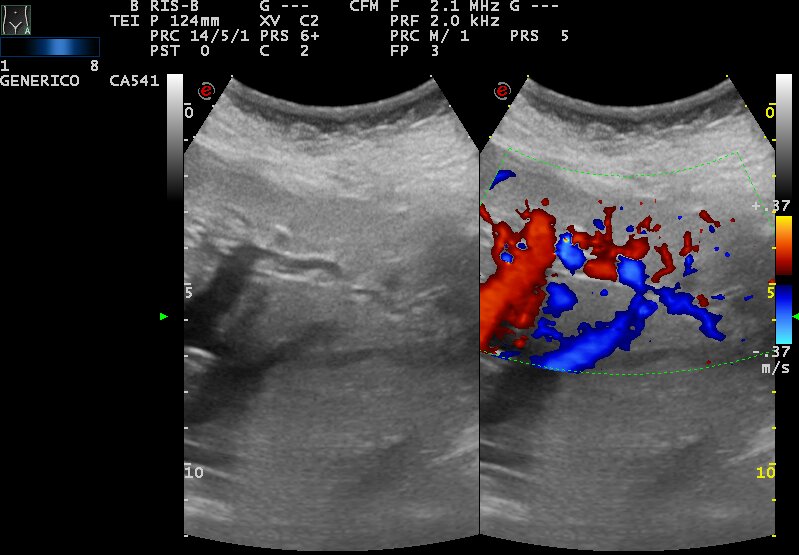 Osler Weber Rendu Syndrome