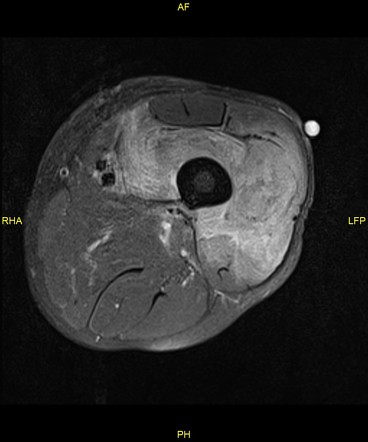 Intramuscular thigh metastasis from esophageal cancer | Image ...