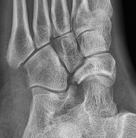 Müller-Weiss syndrome | Radiology Reference Article | Radiopaedia.org