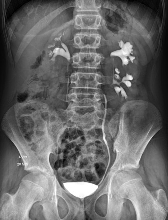 Incomplete left renal duplex collecting system | Radiology Case ...