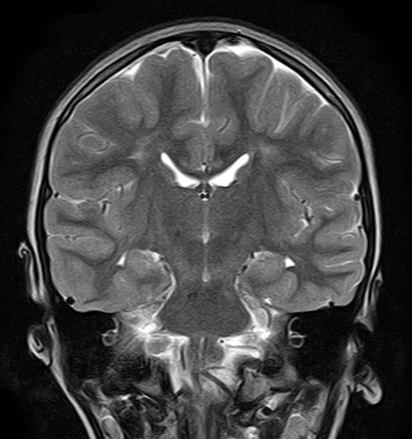 Periventricular Leukomalacia And Quadrigeminal Cistern Arachnoid Cyst