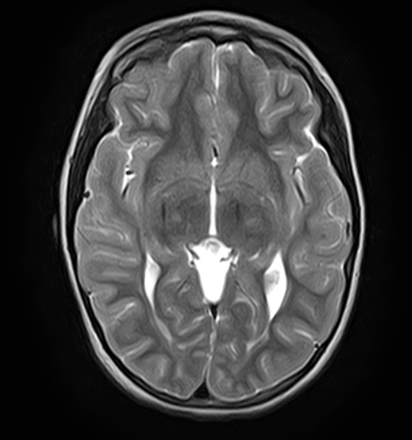 Periventricular leukomalacia and quadrigeminal cistern arachnoid cyst ...