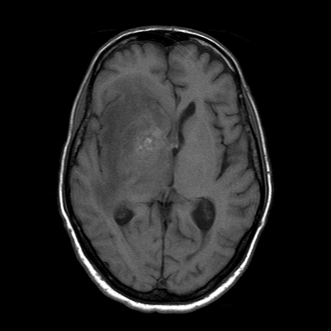 Acute necrotizing toxoplasma encephalitis | Image | Radiopaedia.org