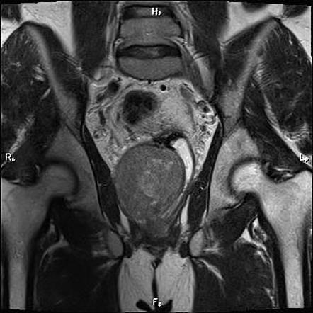 Rectal Gastrointestinal Stromal Tumor 