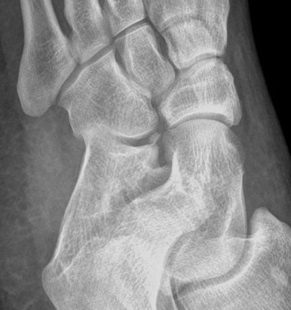 Os calcaneus secundarius | Radiology Reference Article | Radiopaedia.org