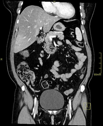 Epiploic appendagitis | Radiology Case | Radiopaedia.org