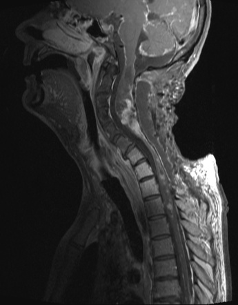 Intradural Extramedullary Metastases Radiology Reference Article Radiopaedia Org