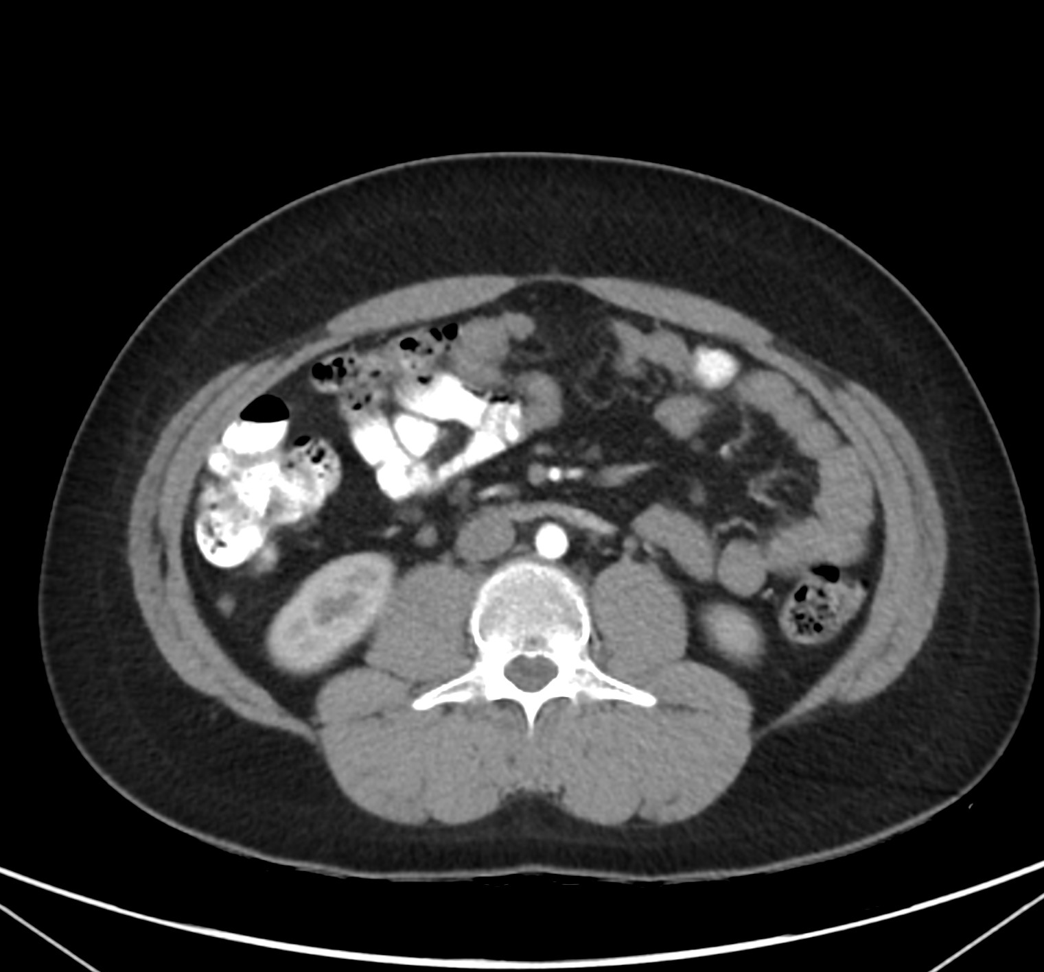 Insulinoma | Image | Radiopaedia.org