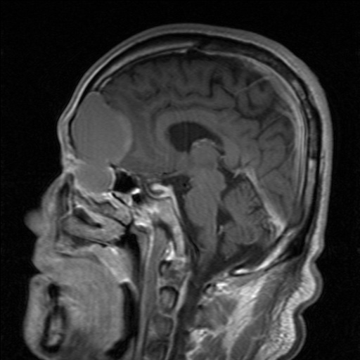 Frontal Mucocele | Image | Radiopaedia.org