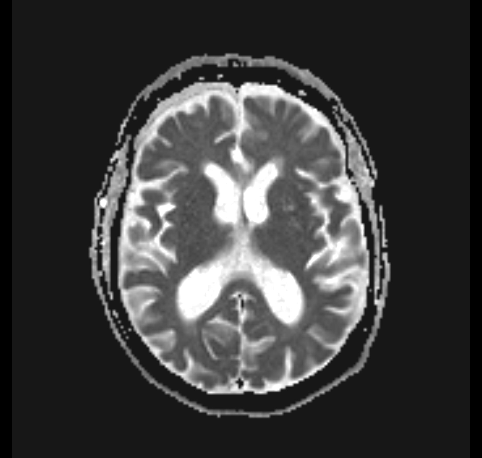 Carotid near-occlusion | Image | Radiopaedia.org