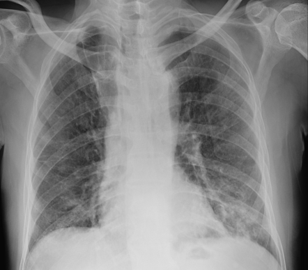 Azygos fissure and lobe | Radiology Case | Radiopaedia.org